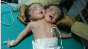 في ظاهرة نادرة .. ولادة طفلة برأسين في بنجلادش