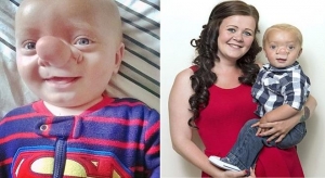 طفل بريطاني ينمو دماغه داخل أنفه بسبب مرض نادر 
