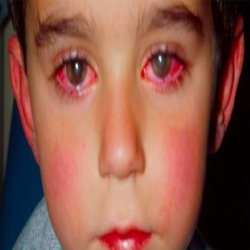 طفل يفقد 75% من بصره بسبب لعبة