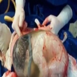  فيديو .. طفل يولد بحالة نادرة داخل "الكيس المشيمي"