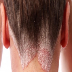 علاج صدفية الشعر 
