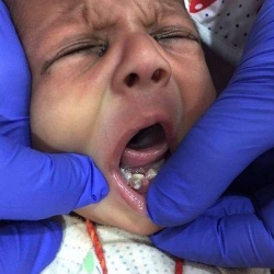 ولادة طفل بسبع أسنان في الهند 
