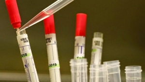  اختبار جديد لتشخيص فيروس "إيبولا" في دقائق