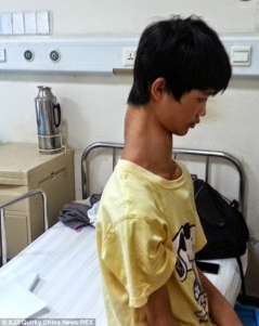 مراهق صيني يخضع لجراحة للتخلص من "رقبته"