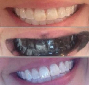 طريقة فعالة لتبييض الاسنان تغنيك عن زيارة الطبيب